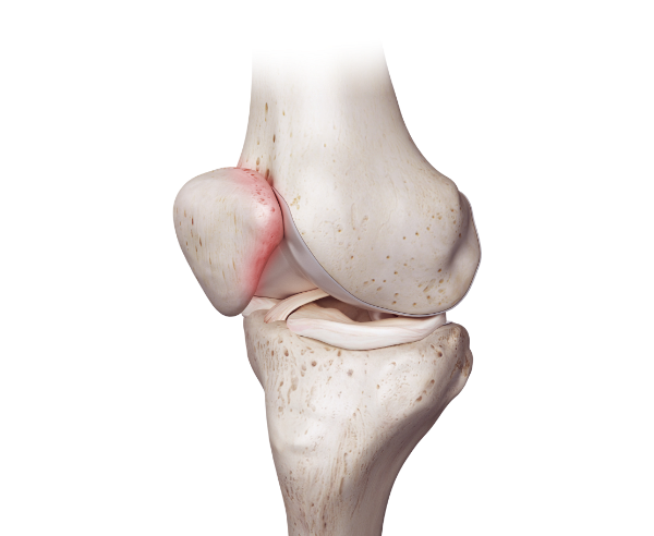 슬개골 연골 연화증